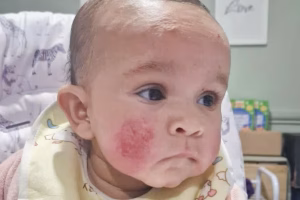 Baby Eczema Getting Worse — What Finally Worked for Us