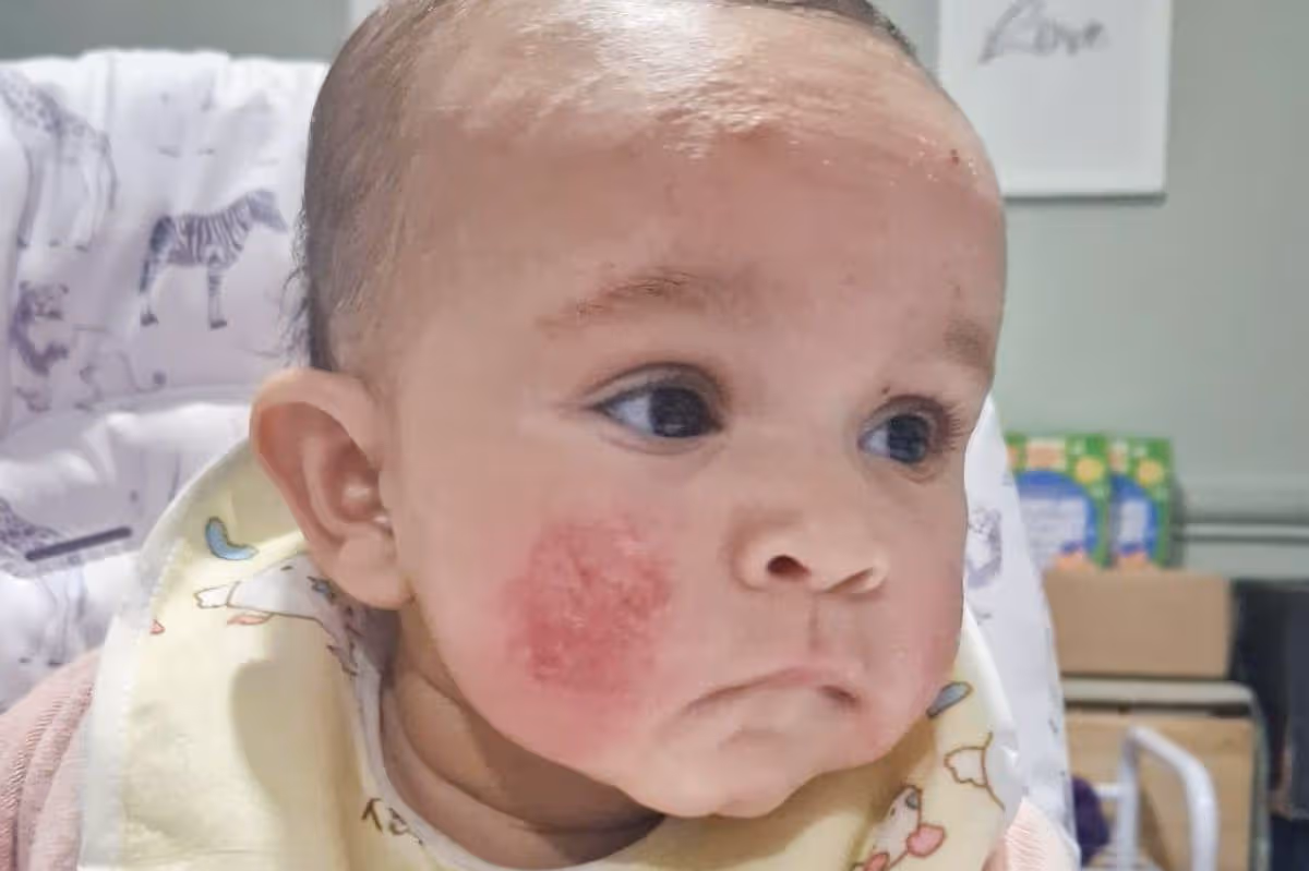 Baby Eczema Getting Worse — What Finally Worked for Us