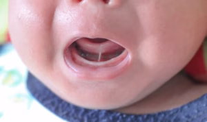 Tongue Tie in Newborns — Everything Nobody Told You